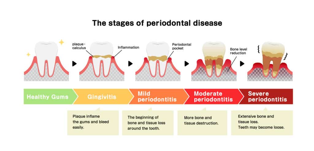 Periodontics - Marina Dentistry