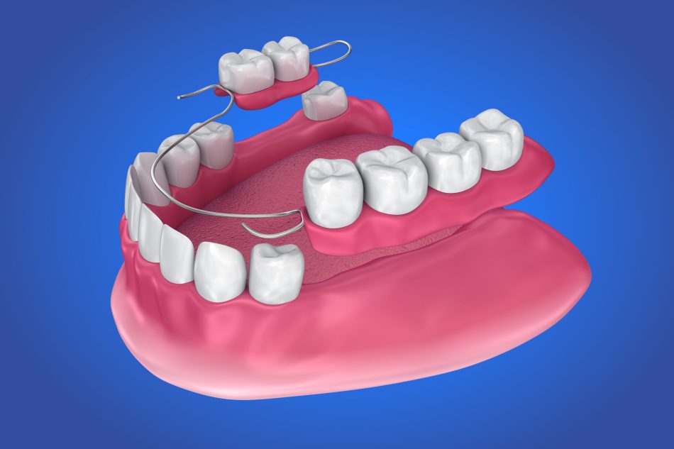 Removable partial denture. Medically accurate 3D illustration